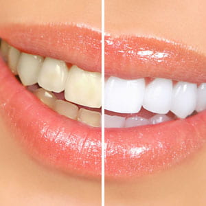 Does Teeth Whitening Really Work?