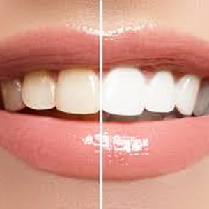 How does teeth whitening work?