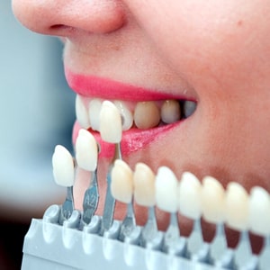 How To Prepare My Teeth for Teeth Whitening?
