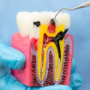 Root Canals in Glendale: Best Foods to Eat After Treatment