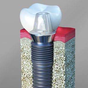 What is a Dental implant and its Benefits
