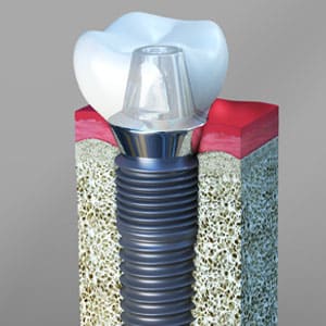 What Is A Dental Implant And Its-Benefits?