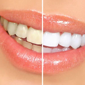 Affordable and Safe Options for Teeth Whitening in Glendale
