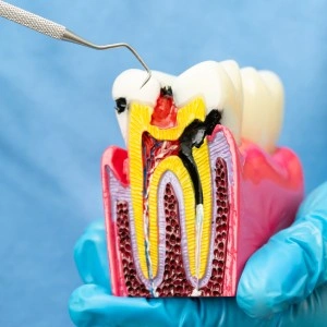 Understanding root canal treatment by a cosmetic dentist in Glendale, showing tooth cross section with infected pulp being cleaned