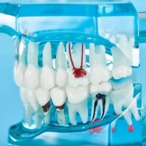 Dental model showing tooth roots and a root canal therapy illustration for root canals in Glendale