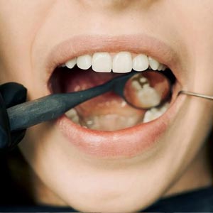 Dental Sealants: For Healthy & Teeth Cleaning