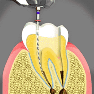 An Overview of Root Canals | Glendale CA