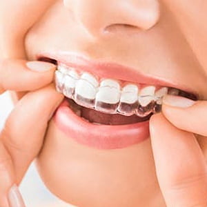 Teeth Whitening After Invisalign Treatment | Glendale, CA