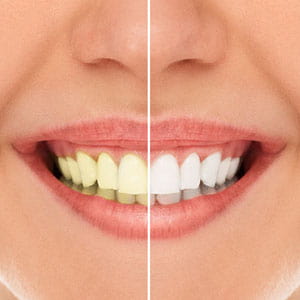 Tips for Professional Teeth Whitening | Glendale, CA