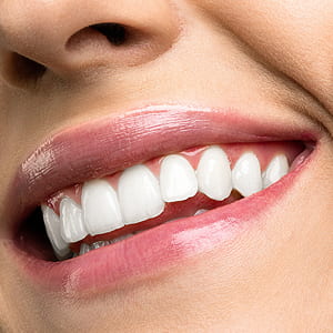 6 Tips on Post Teeth Whitening Treatment | Glendale, CA
