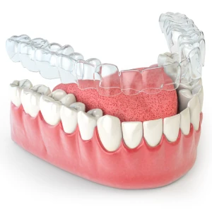 Top Questions About Invisalign Treatments in Glendale Answered