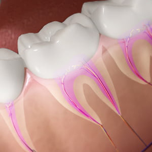 Will the Root Canal Treatment Rescue My Teeth? | Glendale