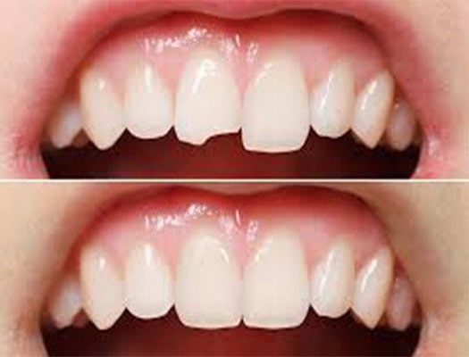 Cosmetic Dental Bonding Glendale