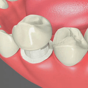 Dental Crowns in Glendale