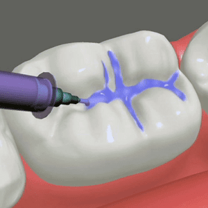 Dental Sealants Glendale