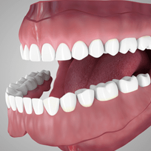 Dentures Glendale California