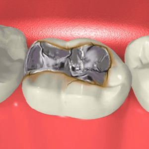 Metal-Free Fillings Glendale